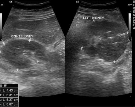 Emphysematous Pyelonephritis Radiology Case Radiopaedia Org