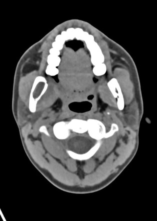 Keratocystic Odontogenic Tumor Image Radiopaedia Org