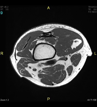 Intramuscular Lipoma Radiology Case Radiopaedia Org