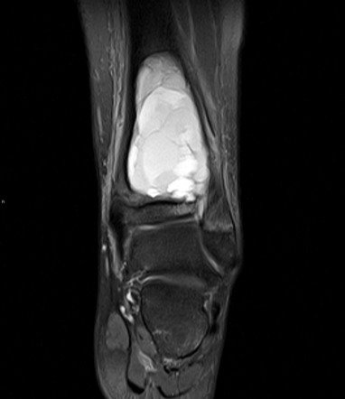 Aneurysmal Bone Cyst Radiology Case Radiopaedia Org