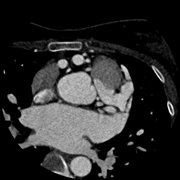 Cardiac Ct Radiology Reference Article Radiopaedia Org