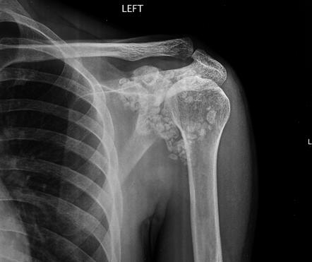 Synovial Chondromatosis Of Shoulder Radiology Case Radiopaedia Org