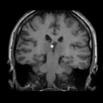 Pericallosal Lipoma Radiology Reference Article Radiopaedia Org