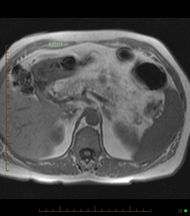 Fatty Replacement Of The Pancreas Image Radiopaedia Org