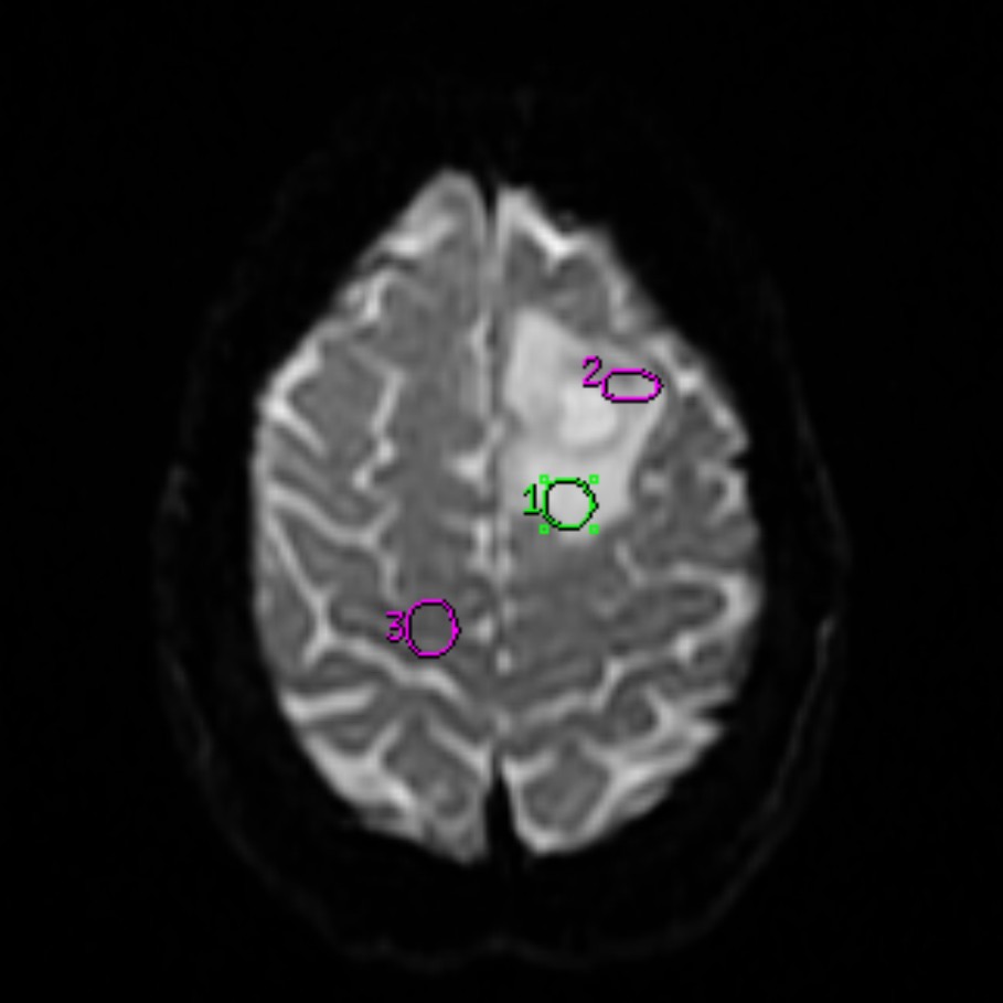 Glioblastoma Nos Image Radiopaedia Org