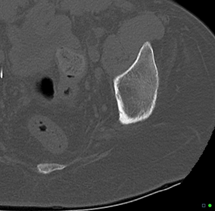 Ischium Pressure Ulcer Hot Sex Picture