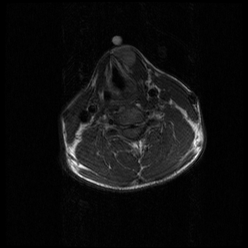 Thyroglossal Duct Cyst Image Radiopaedia Org