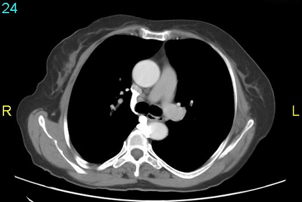 Left Superior Intercostal Vein Radiology Reference Article