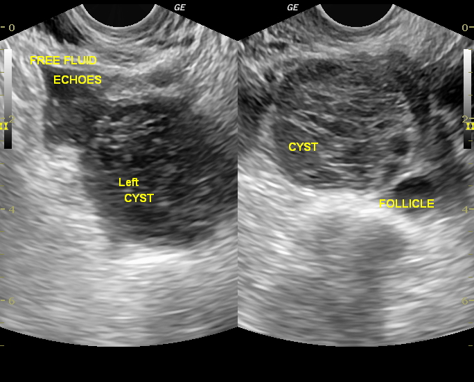 Ruptured Haemorragic Corpus Luteal Cyst Image Radiopaedia Org