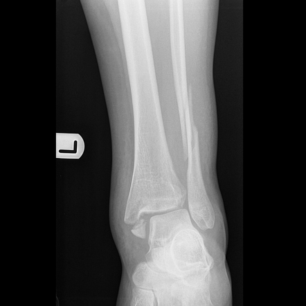 Trimalleolar Ankle Fracture Radiology Case Radiopaedia Org