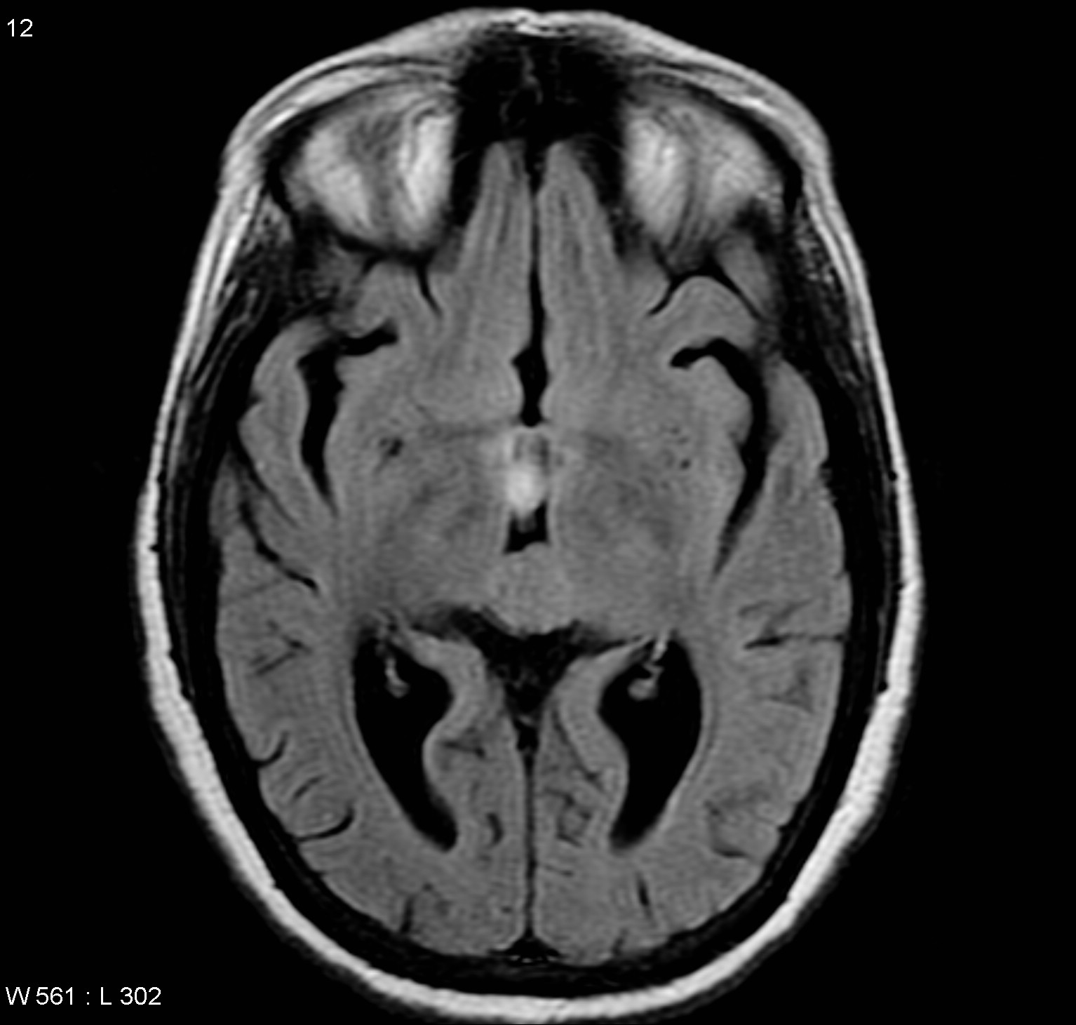 Pineocytoma Causing Hydrocephalus Image Radiopaedia Org