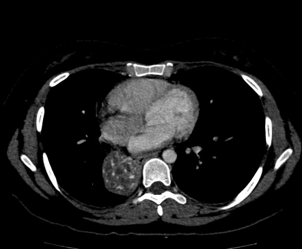 Pulmonary Sequestration Intralobar Radiology Case Radiopaedia Org