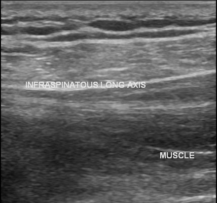 Intramuscular Cyst With Supraspinatus Tear Image Radiopaedia Org