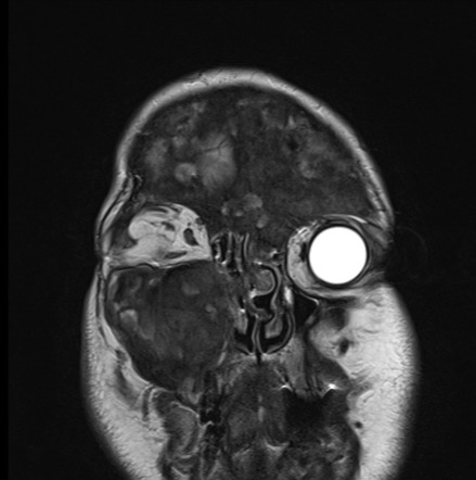 Playlist Fibrous Dysplasia Mri By Dr Reuben Schmidt