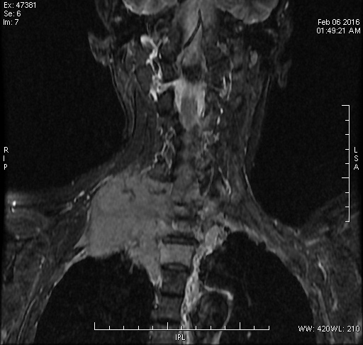 Pancoast Tumor Image Radiopaedia Org