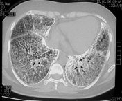 Pulmonary Alveolar Microlithiasis Radiology Reference Article Radiopaedia Org