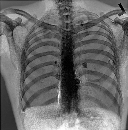 Calcified Abdominal Lymph Nodes Image Radiopaedia Org