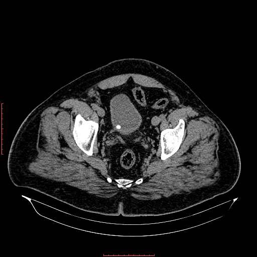 Urinary Bladder Hernia And Calculi Image Radiopaedia Org