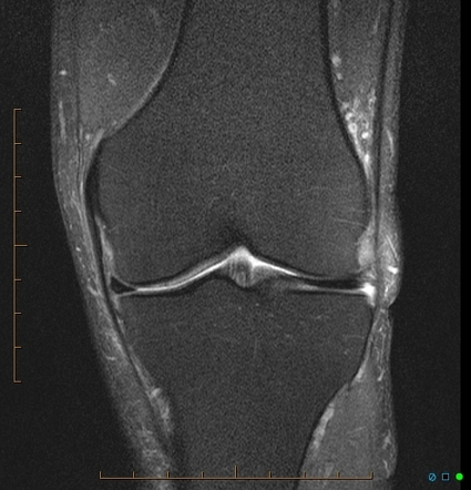 Popliteus Tendinopathy Image Radiopaedia Org