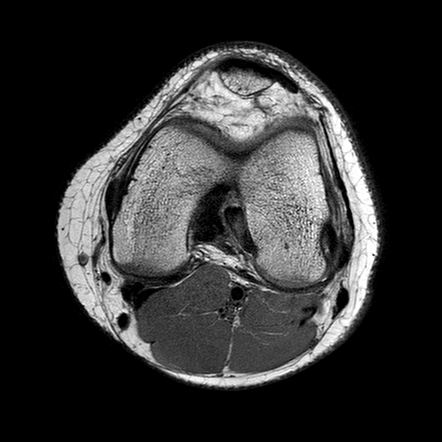 Popliteus Tendon Radiology Reference Article Radiopaedia Org