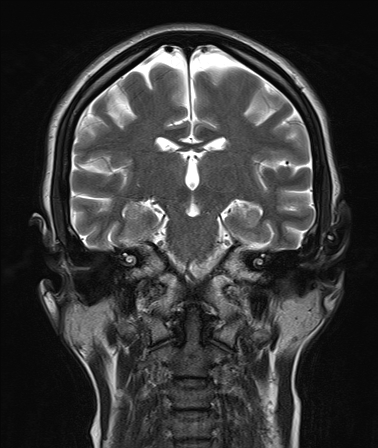 Tuberculum Sellae Meningioma Image Radiopaedia Org