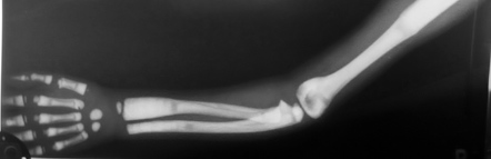 Osteopetrosis Autosomal Dominant Image Radiopaedia Org