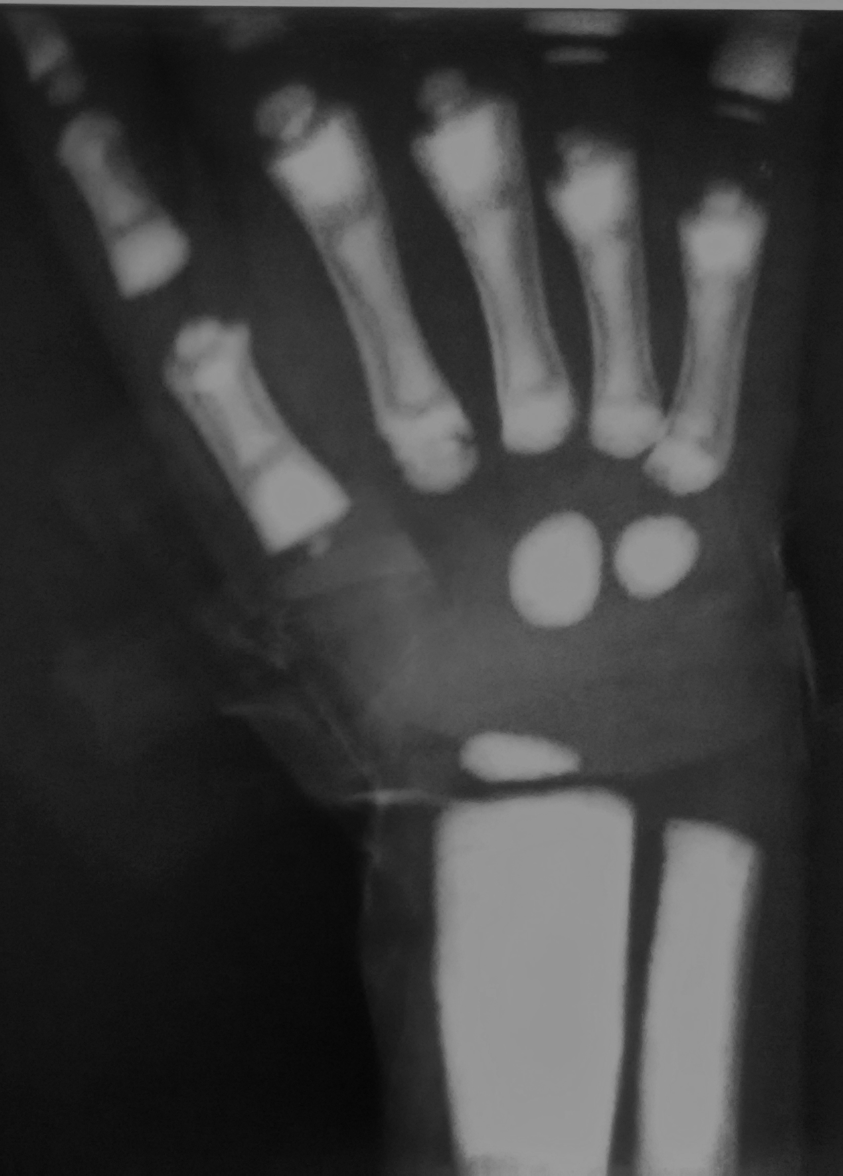 Osteopetrosis Autosomal Dominant Image Radiopaedia Org