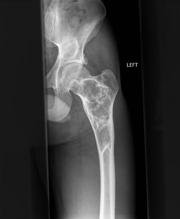 Fibrous Dysplasia Radiology Case Radiopaedia Org