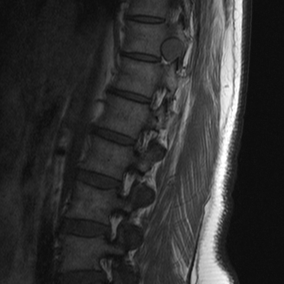 Dumbbell Schwannoma Of The Thoracic Spine Image Radiopaedia Org