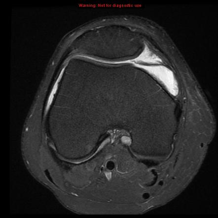 Medial Plica Syndrome Knee