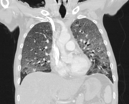 Pneumocystis Pneumonia Radiology Case Radiopaedia Org