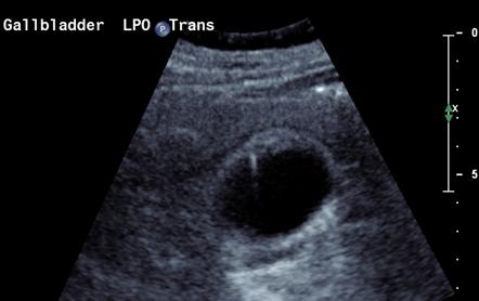 Adenomyomatosis Of The Gallbladder Radiology Reference Article