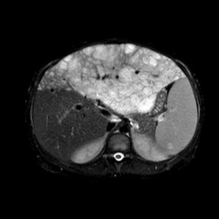 Hepatic Epithelioid Hemangioendothelioma Image Radiopaedia Org