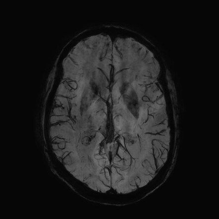 Fronto Temporal Lobar Degeneration Logopaenic Aphasia Image