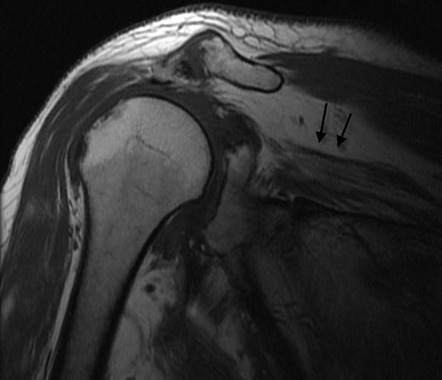 Rotator Cuff Tear Radiology Reference Article Radiopaedia Org