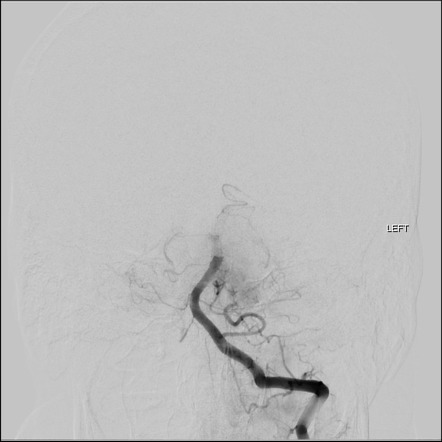 Clot Meniscus Sign Angiography Radiology Reference Article