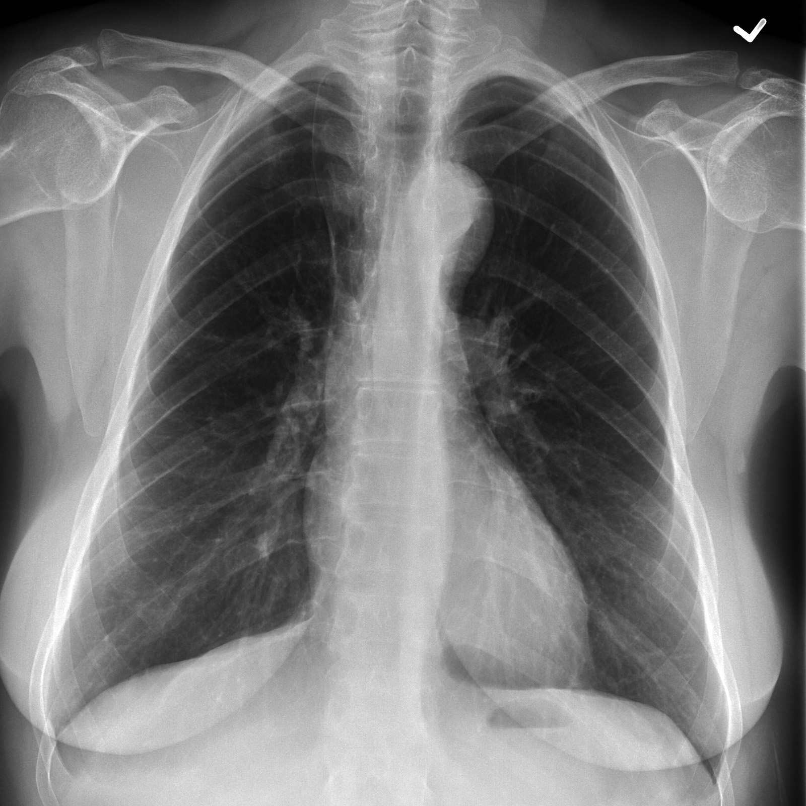 Azygos Fissure Radiology Case Radiopaedia Org