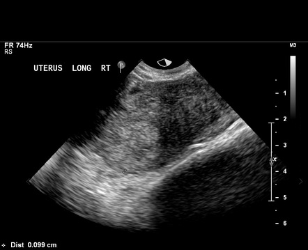 Interstitial Ectopic Pregnancy Radiology Case Radiopaedia Org