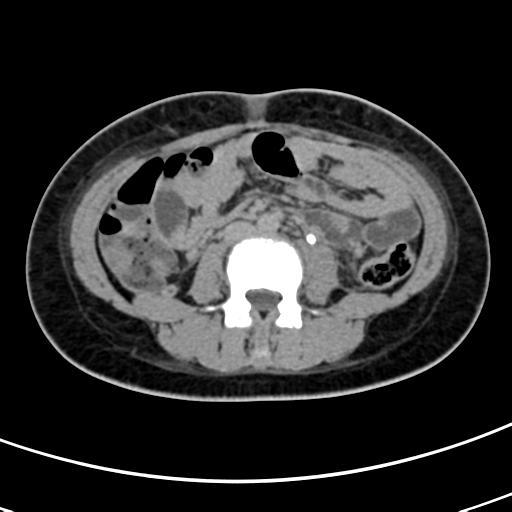 Acute Suppurative Pyelonephritis Image Radiopaedia Org