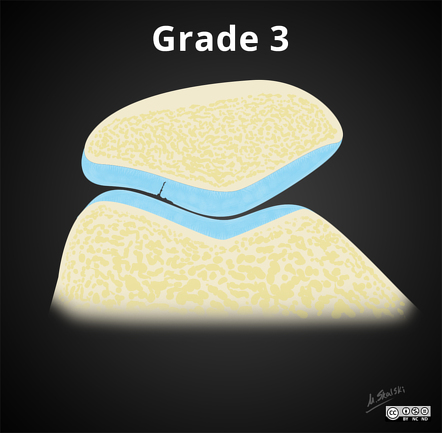 Modified Outerbridge Grading Of Chondromalacia Radiology Reference