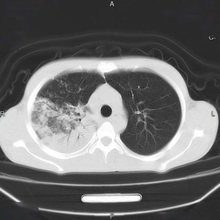 Pulmonary Tuberculosis Radiology Case Radiopaedia Org