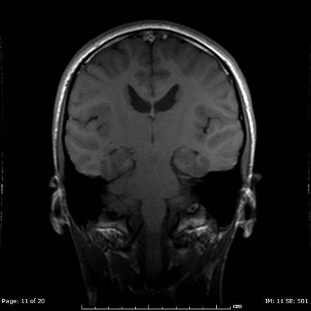 Subependymal Grey Matter Heterotopia Image Radiopaedia Org