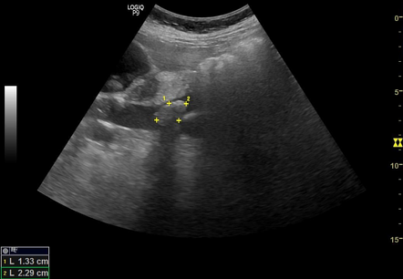 Cholelithiasis And Choledocholithiasis Image Radiopaedia Org