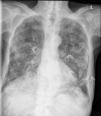 Pleural Plaque Radiology Reference Article Radiopaedia Org