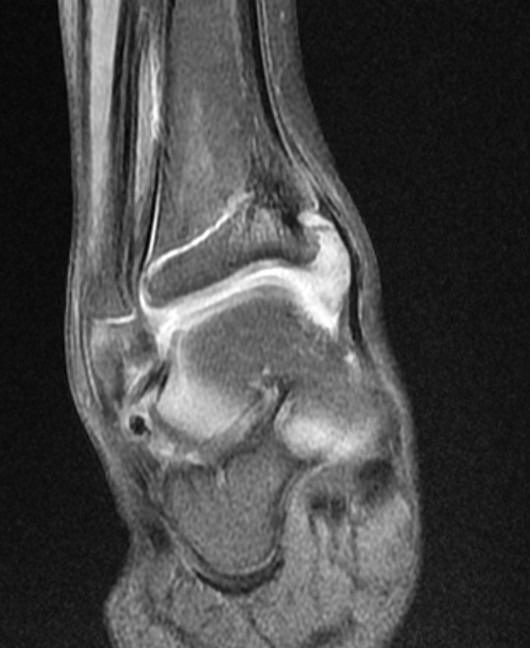 Physeal Bar Image Radiopaedia Org