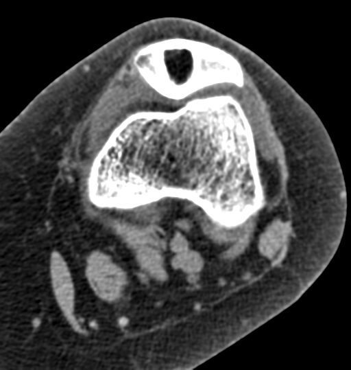 Intraosseous Lipoma Of The Patella Image Radiopaedia Org