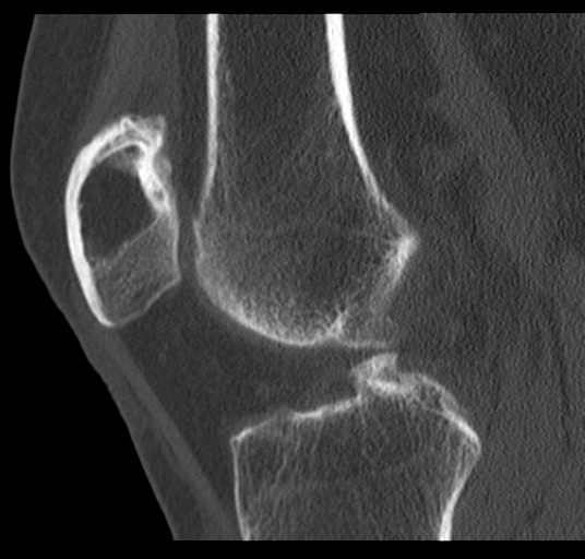 Intraosseous Lipoma Of The Patella Image Radiopaedia Org