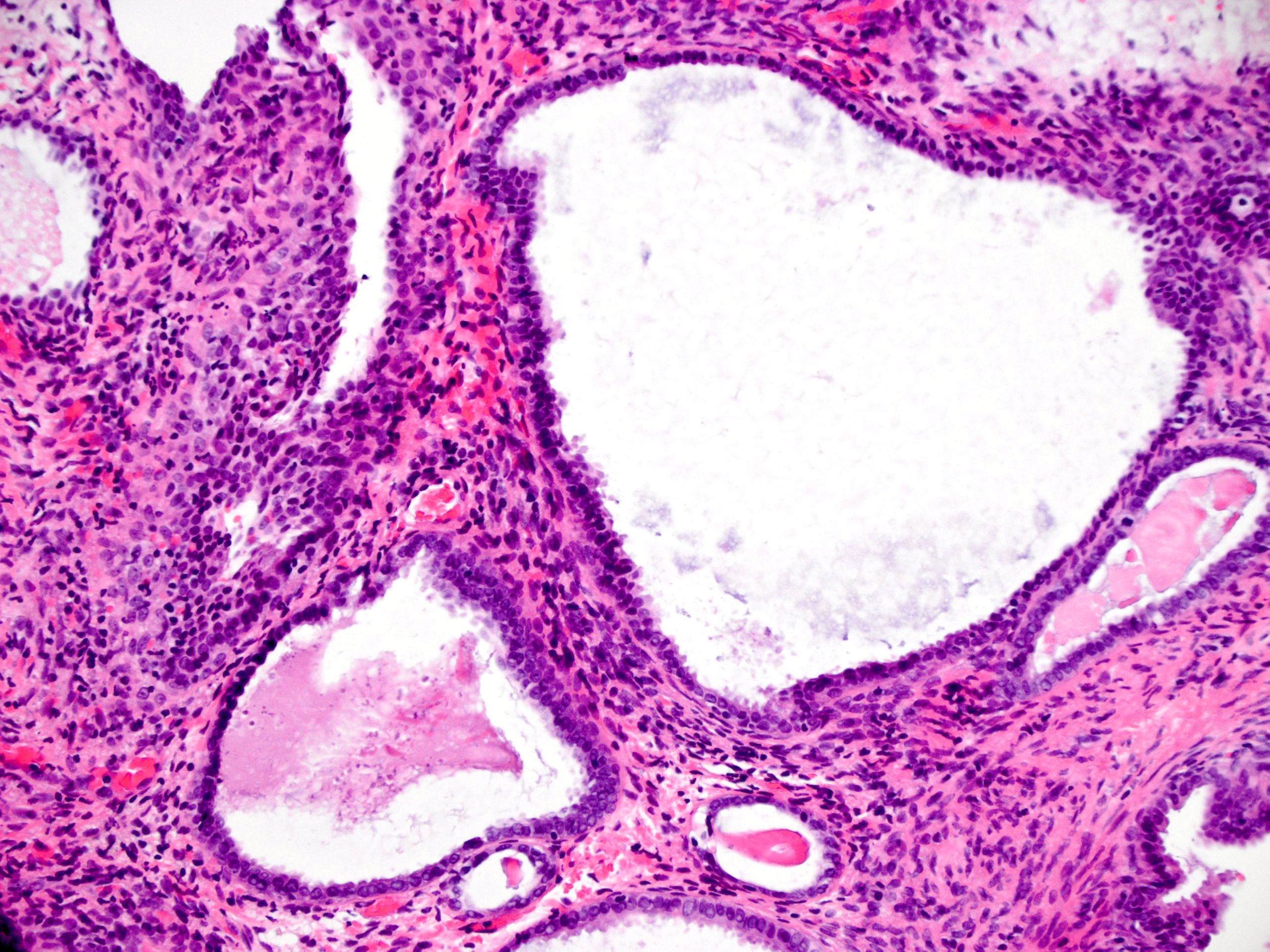 Endometrial Polyp With Complex Hyperplasia And Atypia Pathology