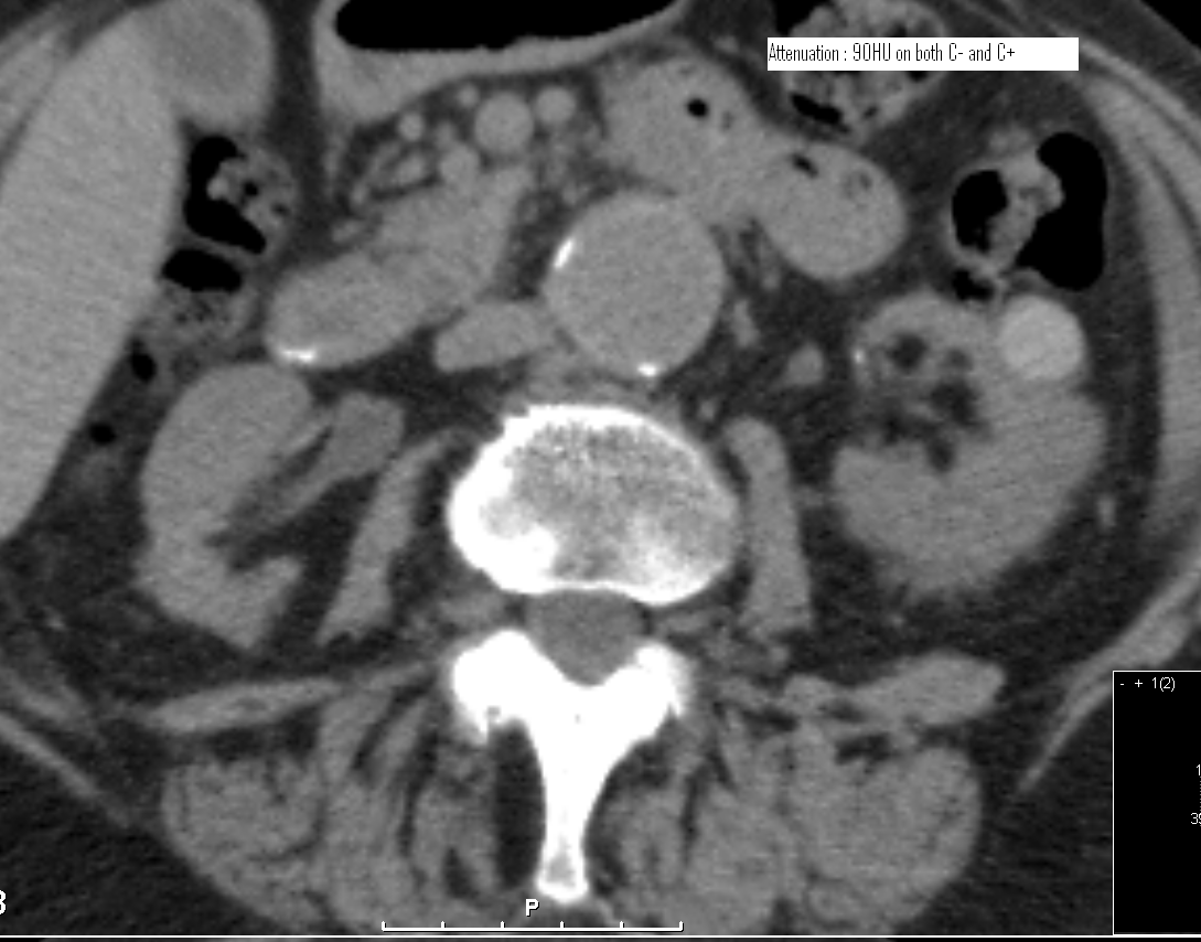 Bosniak Renal Cyst Hemorrhagic Cyst Type Ii Image Radiopaedia Org