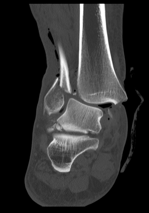 Trimalleolar Fracture Image Radiopaedia Org